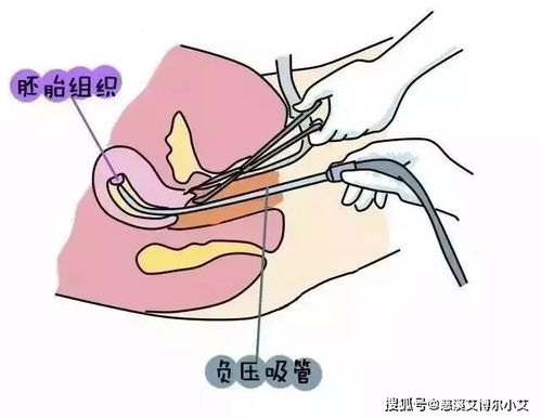 药流和人流的区别 慈溪艾博尔小艾告诉你的一组图让你明白