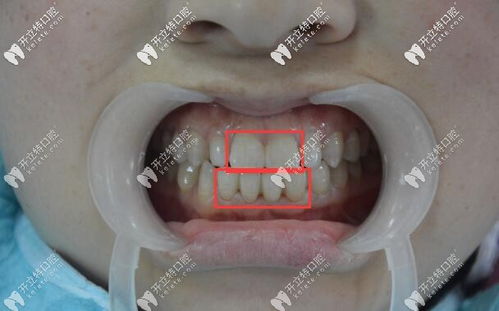 这是她门牙做6颗爱尔创全瓷牙修复前后的对比照片哦
