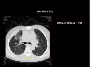 史上最全肺CT分段及典型疾病影像 转载