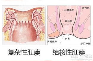 肛瘘是如何分类的