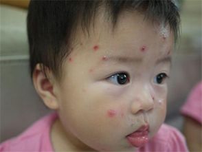 微养生 1 4岁的宝宝,是水痘易发群体