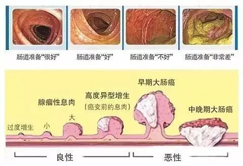 一位32岁肠癌患者的悔悟 我是如何一步步把自己 作 成癌的