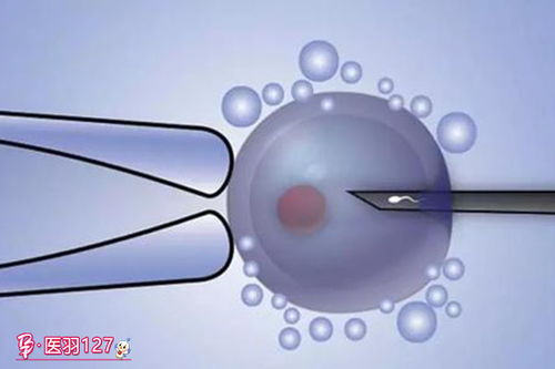试管婴儿治疗对男方的精子一般有哪些要求？