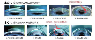 兰州哪里近视手术做的好 飞秒还是半飞秒呢 