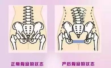 产后骨盆没修复的危害竟然这样大, 测测你的骨盆修复了吗