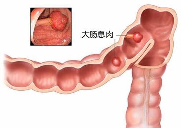 消化科普丨得了大肠息肉,到底要不要紧