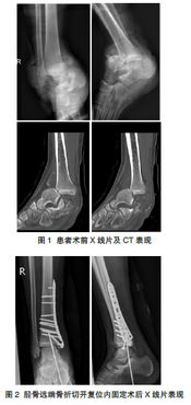 踝关节创伤性关节炎带护踝有用吗 哪种好·(007412)