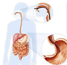 省医药院附院胃肠主任解读 为什么内镜检查很有必要