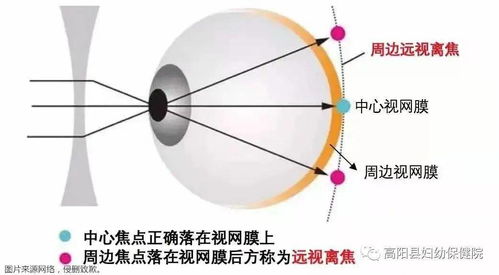 经常喝碳酸饮料,真的会加速近视度数增加