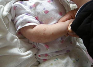 宝宝湿疹遇到的问题,宝宝湿疹在呢么治疗