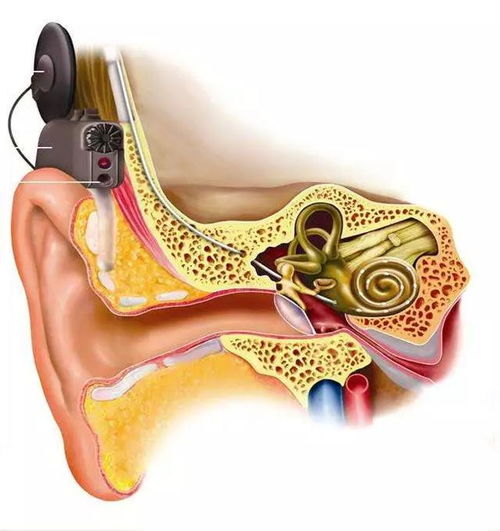 中国老人不愿装人工耳蜗的三大原因