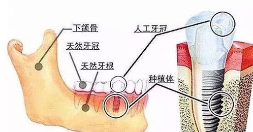 种植牙不止是老年人的专利,年轻人缺牙也选种植牙