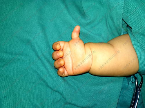 宝宝的左手多指,右手漂浮拇是由哪些原因引起的