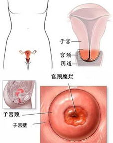 宫颈糜烂图片(宫颈糜烂的症状及图片)