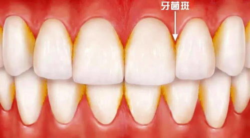 科普丨牙龈炎和牙周炎有什么区别 哪个更严重