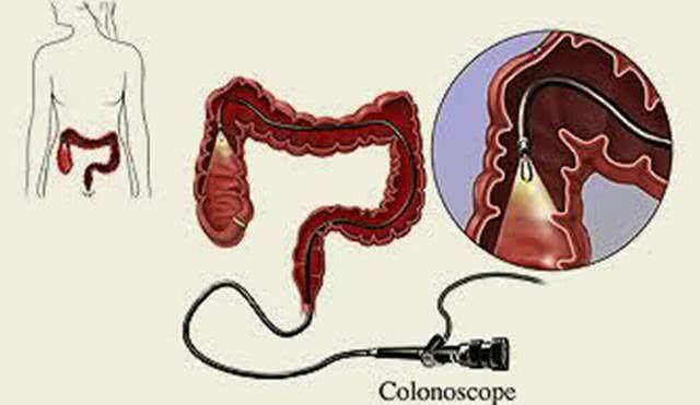 每个人到40岁都该做一次的检查 肠镜,有什么注意事项和危害