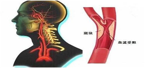 61岁阿姨慢性血管闭塞致肢体瘫痪,惠州三院卒中团队运用新技术紧急疏通