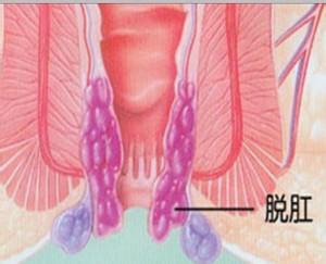 脱肛怎么治疗 脱肛患者的饮食保健