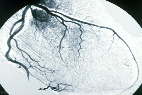 做冠脉造影后人活不久了吗 带来的这4个风险,要了解清楚