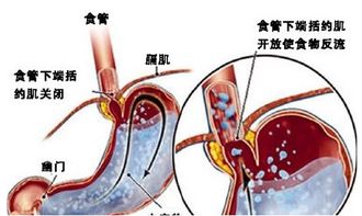 解析食管炎反复发作的原因 