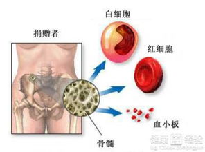 骨髓移植能过感染关吗