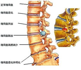 不同姿势腰椎间盘突出压差数倍,站着只能排第二 