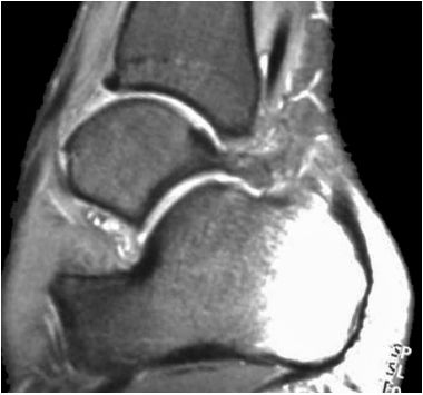 踝关节撞击综合征的影像学诊断