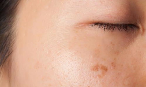 人到老年,如何淡化脸上的老年斑 提醒 3类维生素可多补充