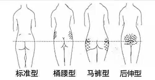 臀部有哪几种臀型