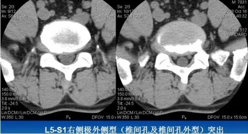 腰45椎间盘突出中央型并椎管继发性狭窄为什么不能牵引和按摩(l4/5椎间盘突出(中央型,椎管狭窄)