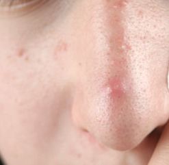 鼻子上长痘痘是什么原因 