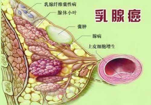 乳腺癌治疗过程中常见的不良反应及管理