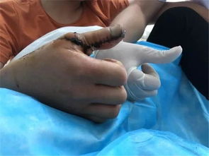 湖南男子大拇指被锯断 17 年,医生用脚趾为其再造拇指,能点赞