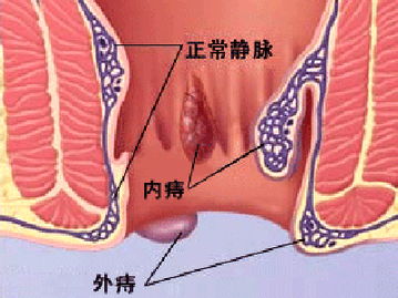 孕晚期小心“痔疮”来做祟