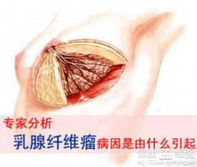 乳腺纤维瘤术后疼痛