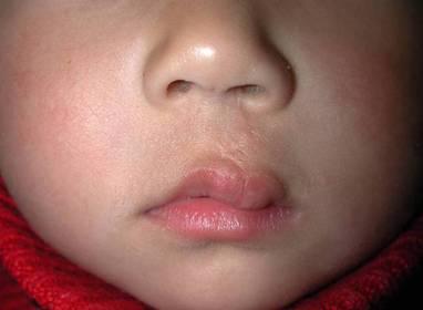 唇裂的孩子需要做第二次唇裂修复手术吗