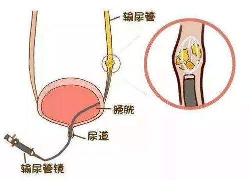 科普讲座丨输尿管镜碎石术后注意事项,您了解多少