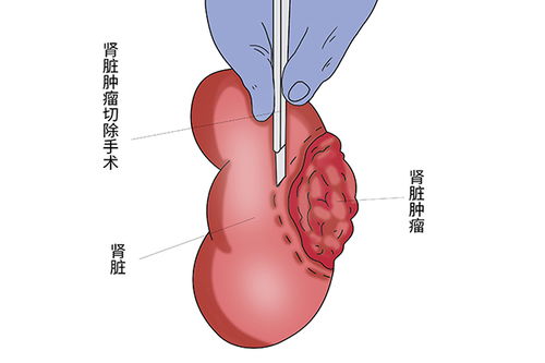 癌症为什么很容易复发 有没有办法预防吗