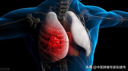 你是 肺癌候选人 吗 这6类职业人群属于高危,建议定期做CT