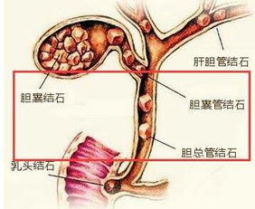 关于胆囊结石的所有知识都在这里 