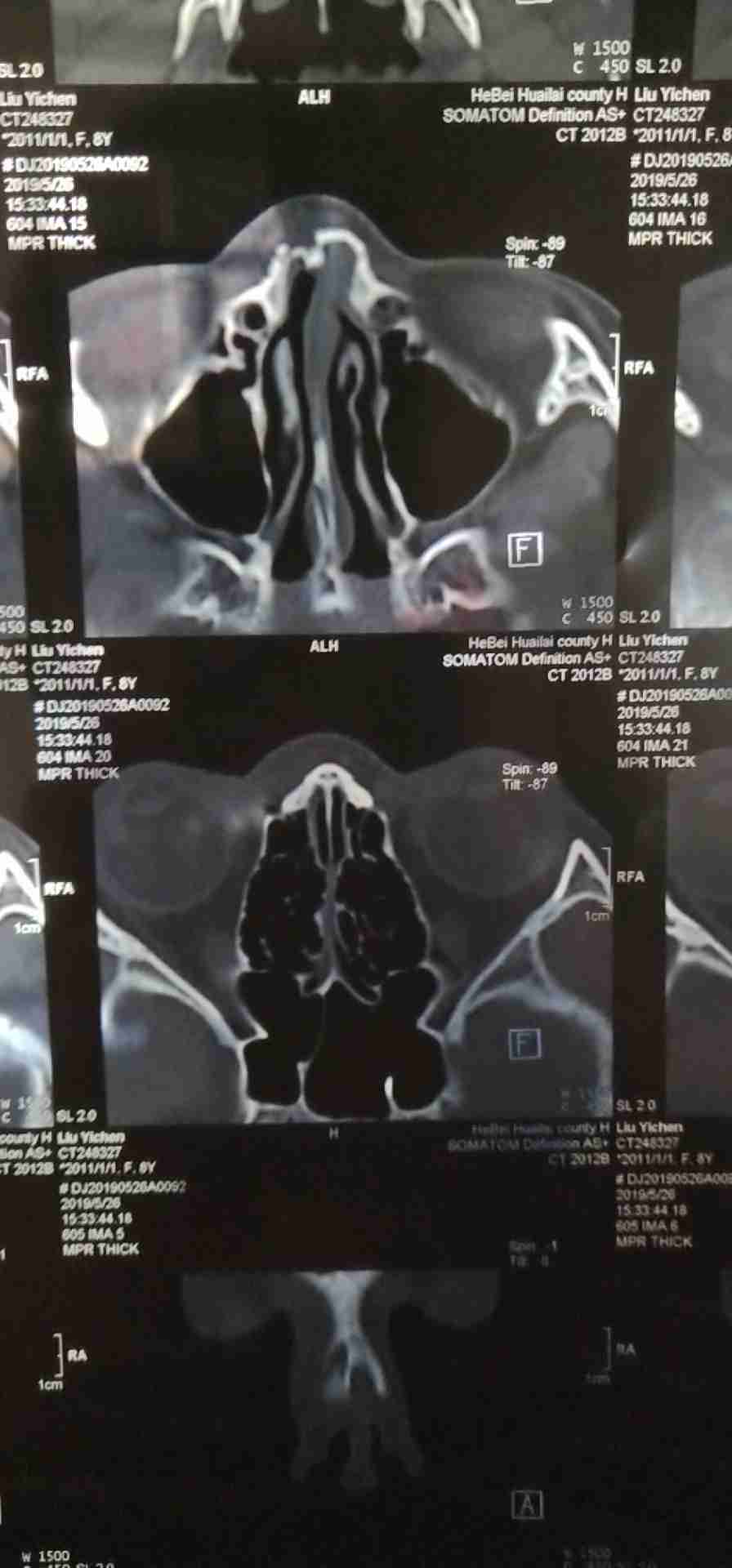 鼻子骨折怎么办