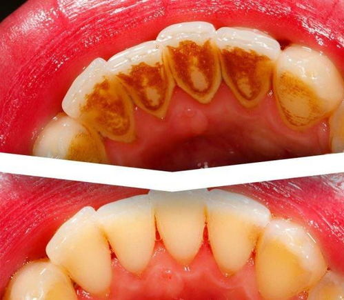 口腔中牙龈的黑三角是怎么形成的 做好以下几点,漏出迷人笑容