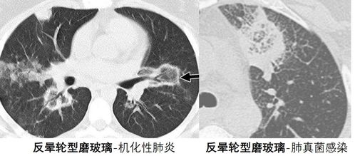 磨玻璃结节是什么原因造成的 类型有哪些