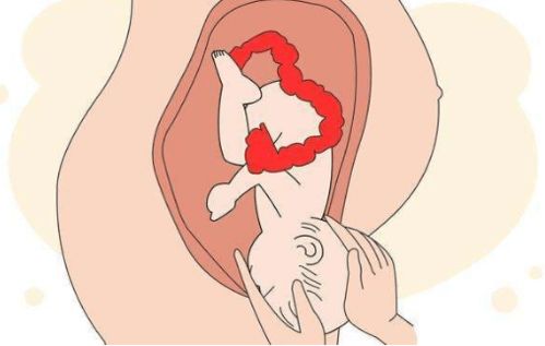 婴儿脐带化脓发炎图片 宝宝快半个月了，脐带下方一圈都红了，好像还有点肿，该怎么处理？ 