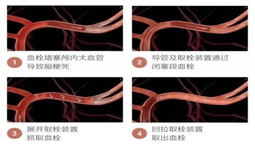 现代取栓术可以取出心脏血管中的血栓吗