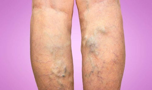 大腿浮肿是什么原因(大腿浮肿是什么原因导致的,肾排尿很正常)