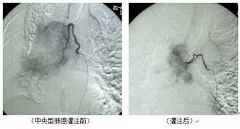 白癫疯靶向定位微创治疗