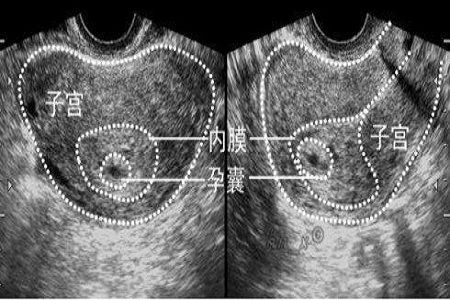 胎儿的性别预测,孕囊的形状看男女真的准吗