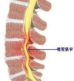 椎管狭窄患者都需要做手术吗 