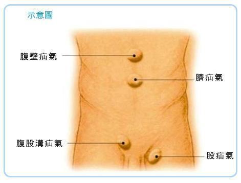 疝气是什么东西 年纪大了一定要注意这些